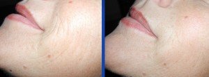 biostimolazione