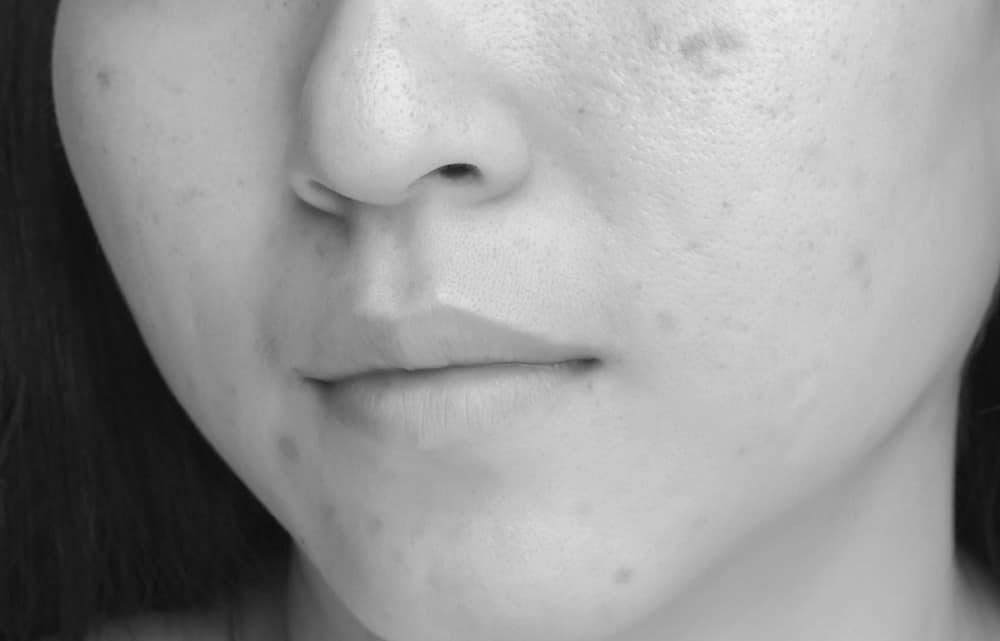 cicatici acne