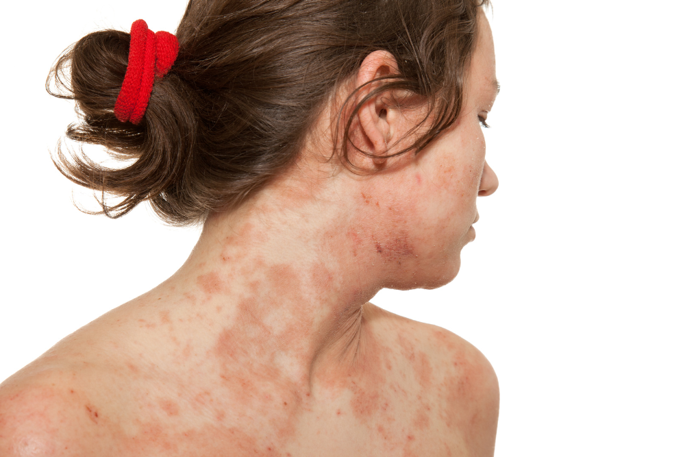 dermatite atopica malattia invalidante