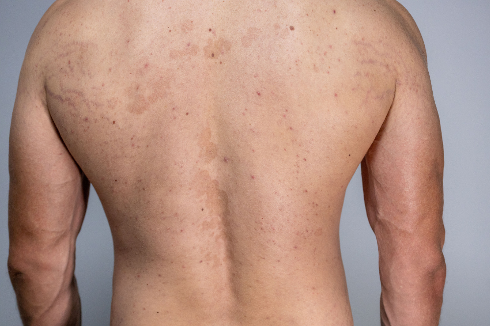 pitiriasi rosea di gibert