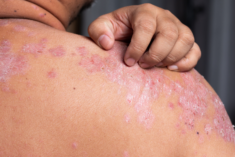 psoriasi dermatite atopica